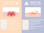 FOCALLURE - Acne Pimple Patch-Day & Night