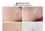 FOCALLURE - Acne Pimple Patch-Day & Night