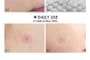 FOCALLURE - Acne Pimple Patch-Day & Night