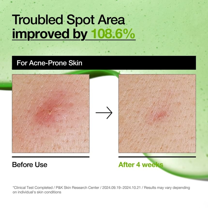 Anua - YesStyle Exclusive Breakout Care Duo Set
