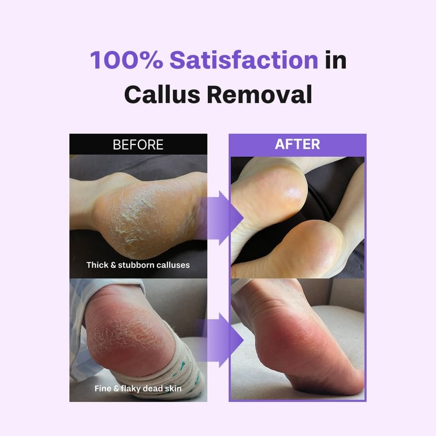baren - Foot Callus Eraser Home Set 2pcs Bundle Set (2 pcs x 2 pcs)
