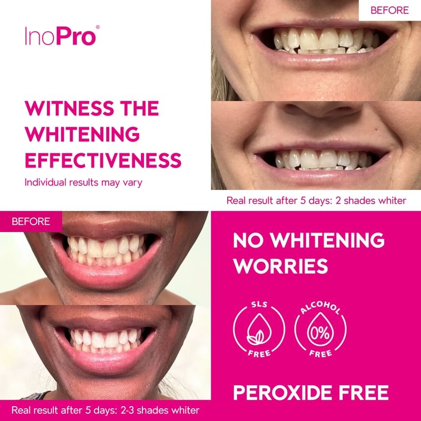 INOPRO - Innovative Whitening Strips (14 treatments/28 strips)