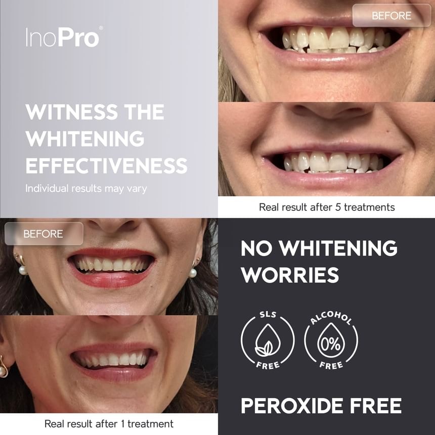 INOPRO - Advanced Whitening Strips (14 treatments/28 strips)